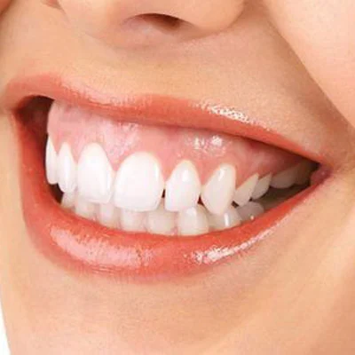 جراحی لبخند لثه ای